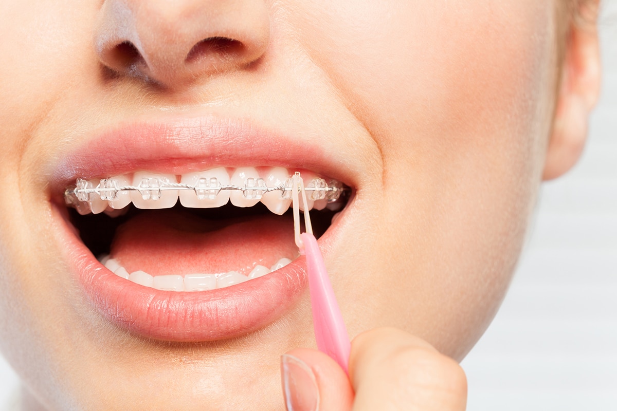 What sets a local orthodontic office apart from corporate chains blog