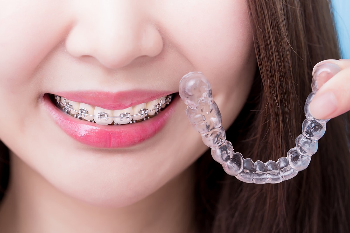 Why orthodontic retainers are important after treatment blog